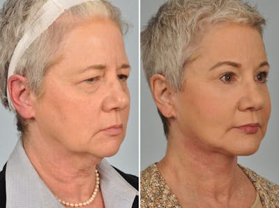 Mid Facelift Before & After Gallery - Patient 353250 - Image 2