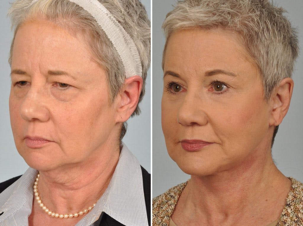 Mid Facelift Before & After Gallery - Patient 353250 - Image 3