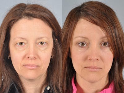 Mid Facelift Before & After Gallery - Patient 394554 - Image 2