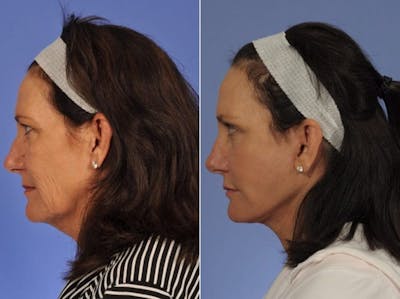 Mid Facelift Before & After Gallery - Patient 323593 - Image 4