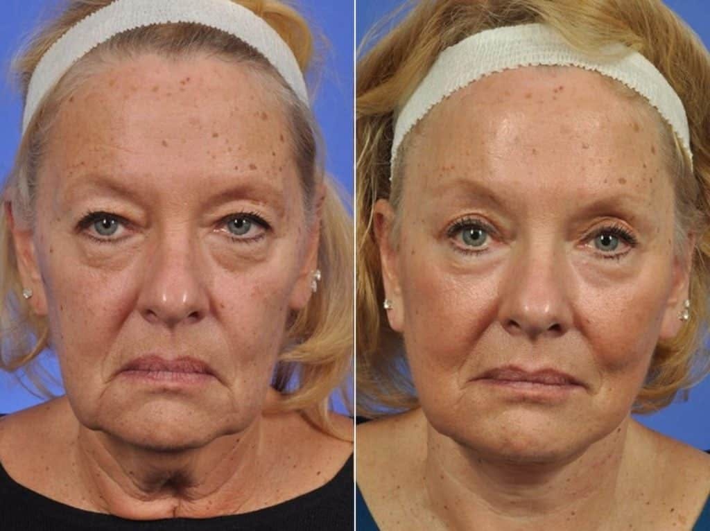Mid Facelift Before & After Gallery - Patient 177242 - Image 1