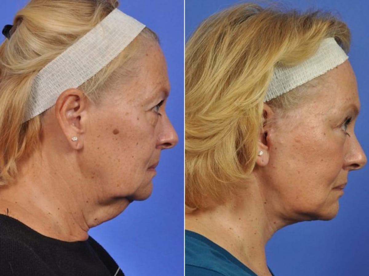 Mid Facelift Before & After Gallery - Patient 177242 - Image 3