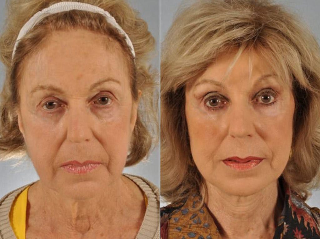 Mid Facelift Before & After Gallery - Patient 227892 - Image 1