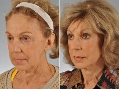 Mid Facelift Before & After Gallery - Patient 227892 - Image 2