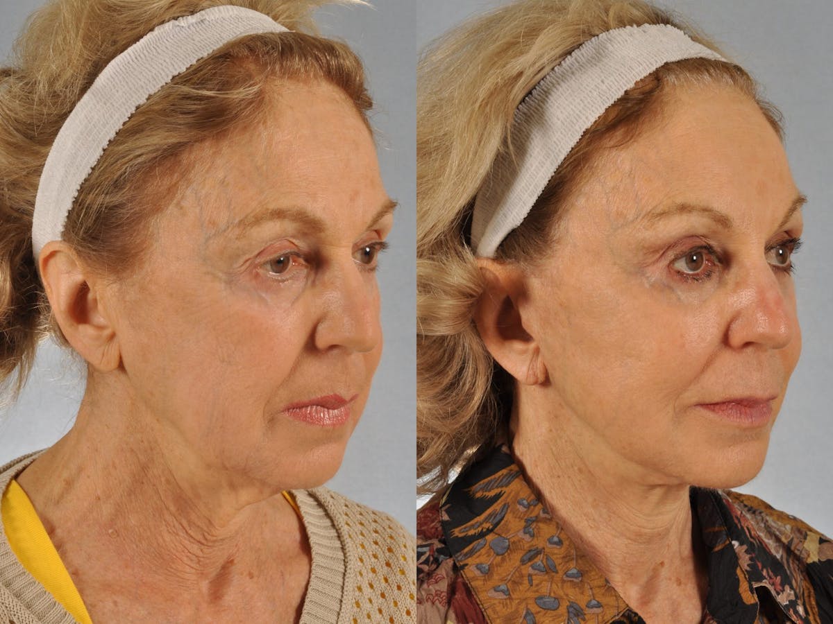 Mid Facelift Before & After Gallery - Patient 227892 - Image 3