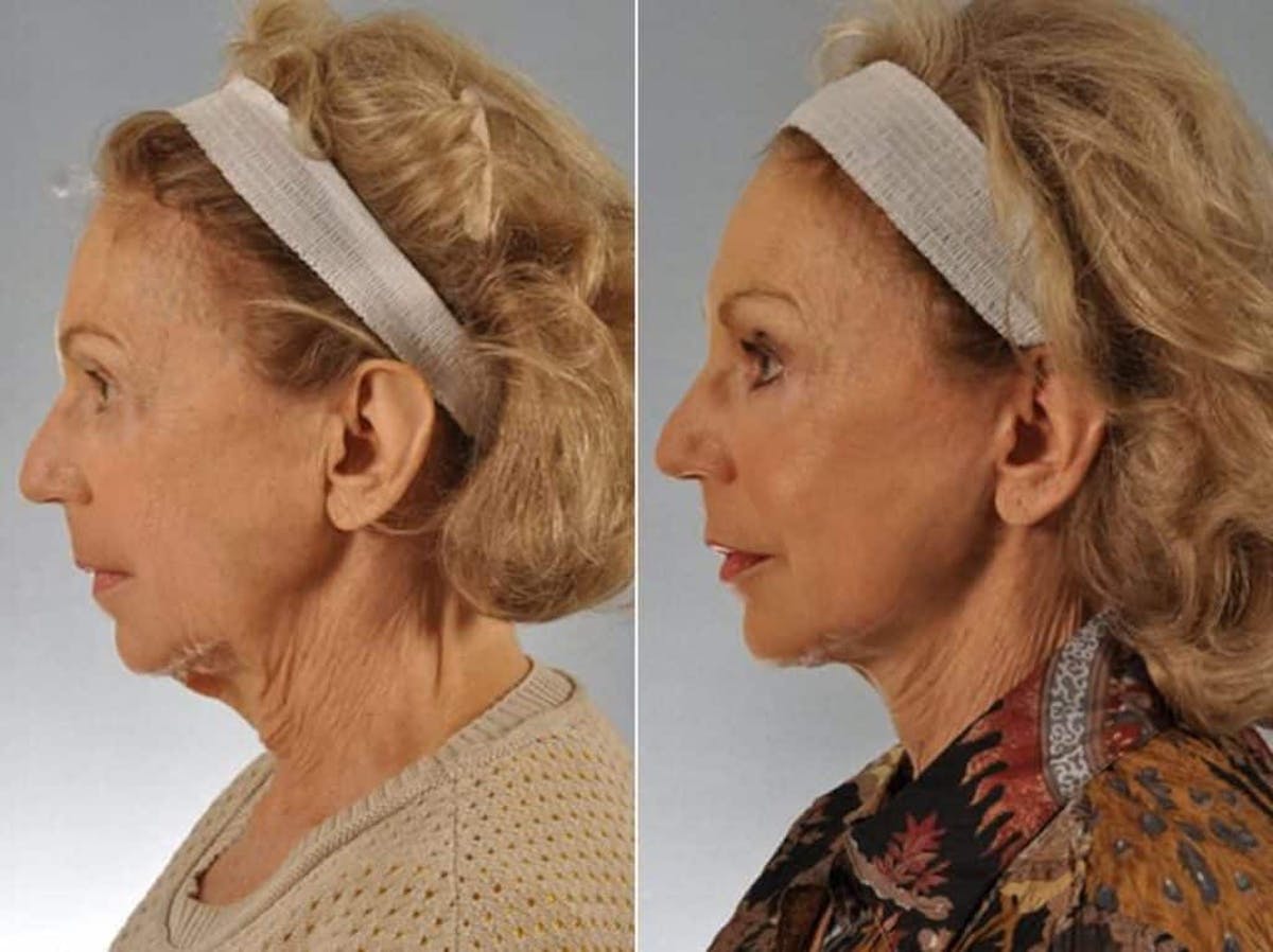 Mid Facelift Before & After Gallery - Patient 227892 - Image 4