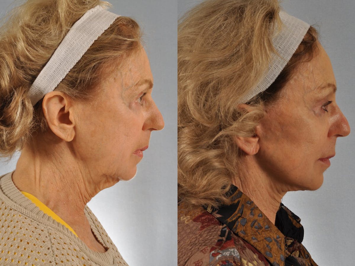 Mid Facelift Before & After Gallery - Patient 227892 - Image 5