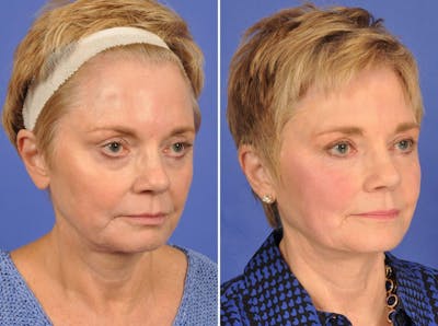 Mid Facelift Before & After Gallery - Patient 126803 - Image 2