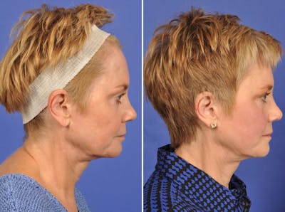 Mid Facelift Before & After Gallery - Patient 126803 - Image 4
