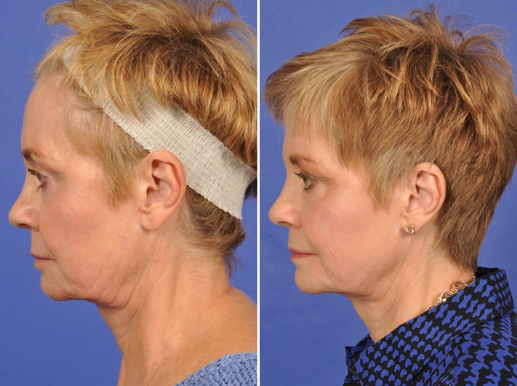 Mid Facelift Before & After Gallery - Patient 126803 - Image 5