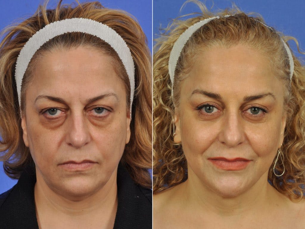 Mid Facelift Before & After Gallery - Patient 197781 - Image 1