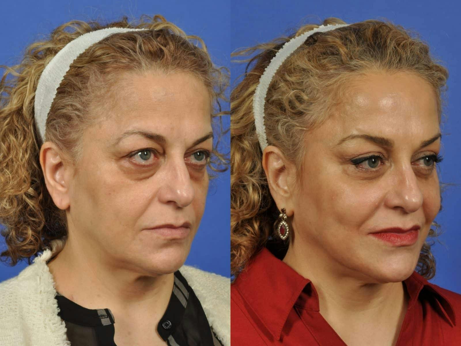 Mid Facelift Before & After Gallery - Patient 197781 - Image 2