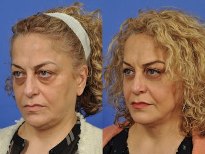 Mid Facelift Before & After Gallery - Patient 197781 - Image 3
