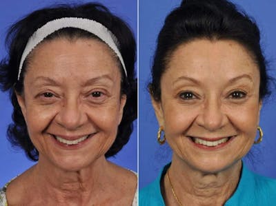 Mid Facelift Before & After Gallery - Patient 286431 - Image 2