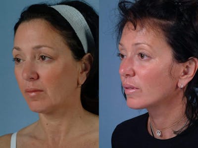 Mini Facelift Before & After Gallery - Patient 894929 - Image 3