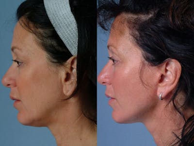 Mini Facelift Before & After Gallery - Patient 894929 - Image 4