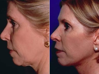 Mini Facelift Before & After Gallery - Patient 324700 - Image 3