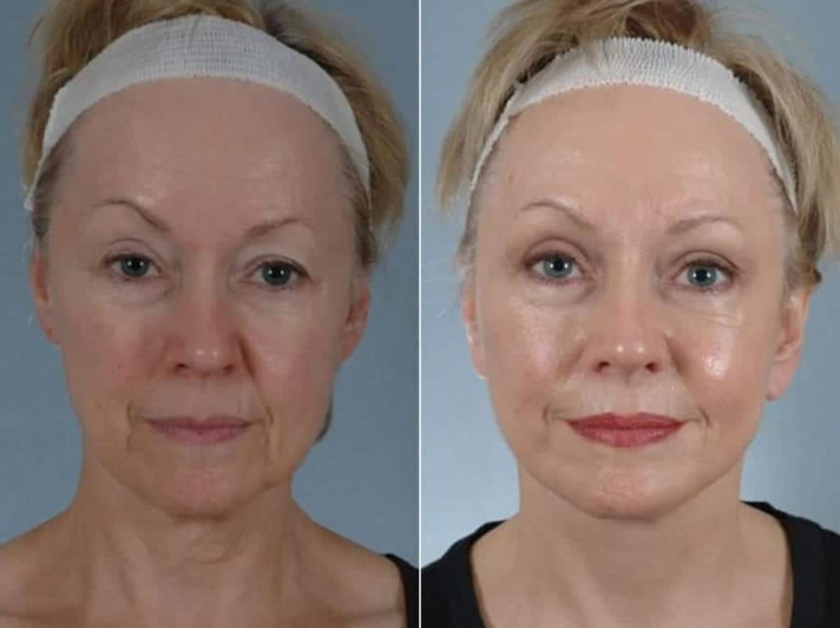 Mini Facelift Before & After Gallery - Patient 709705 - Image 1