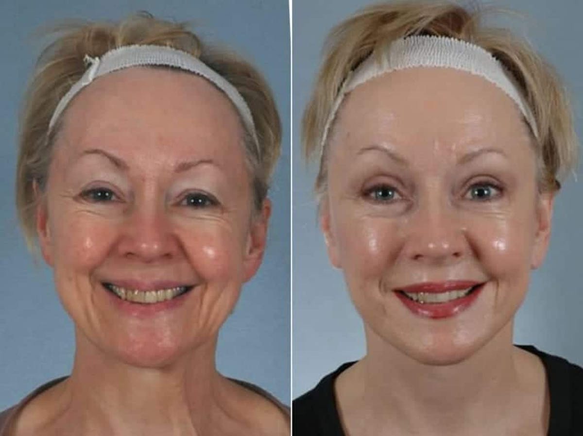 Mini Facelift Before & After Gallery - Patient 709705 - Image 2