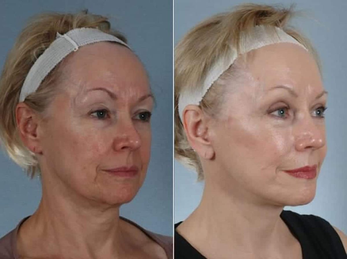 Mini Facelift Before & After Gallery - Patient 709705 - Image 4
