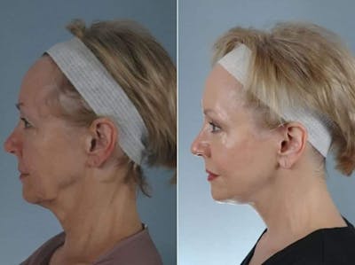 Mini Facelift Before & After Gallery - Patient 709705 - Image 5