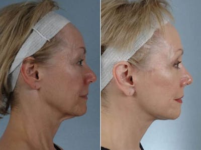 Mini Facelift Before & After Gallery - Patient 709705 - Image 6