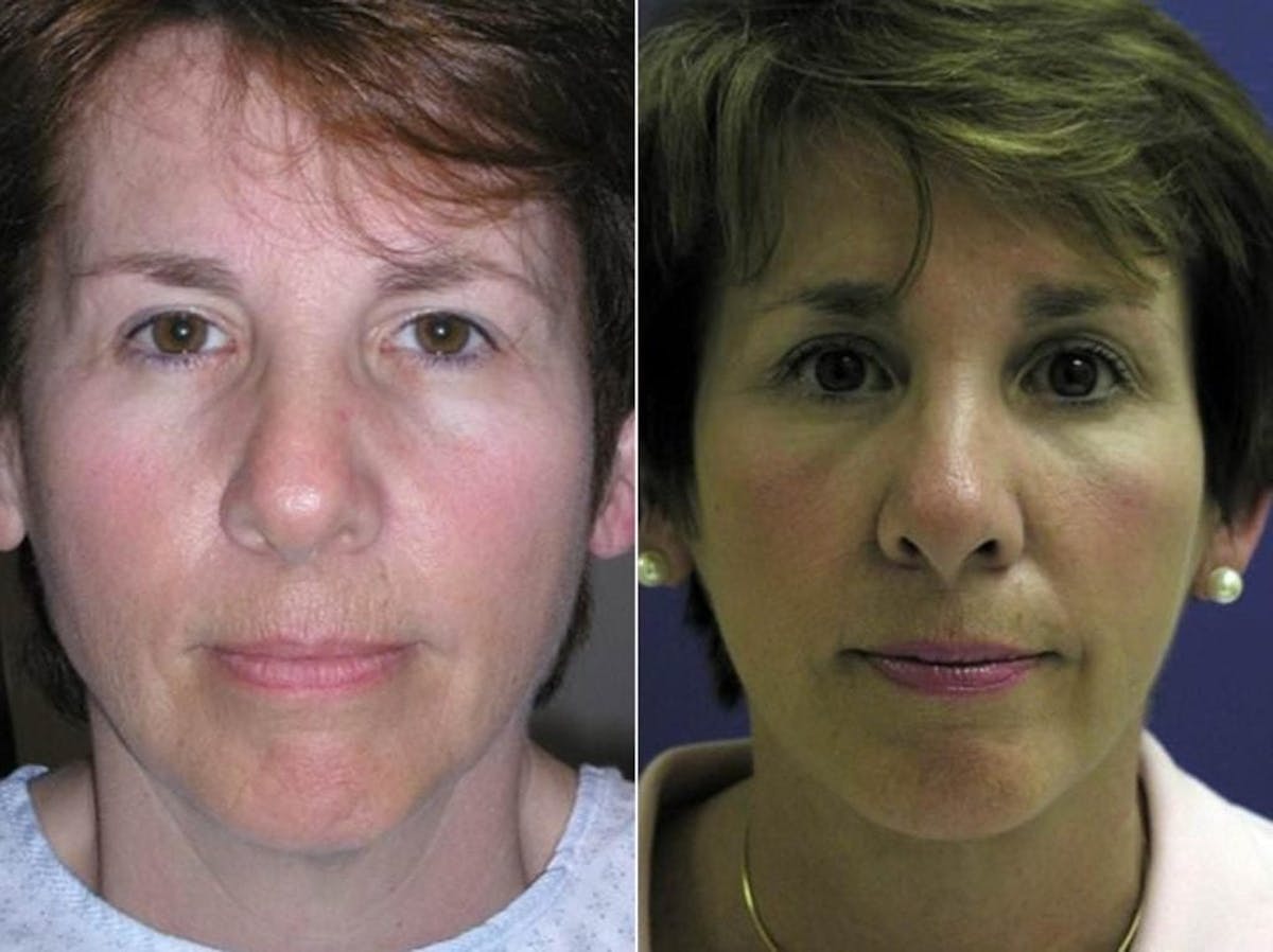 Mini Facelift Before & After Gallery - Patient 106918 - Image 1