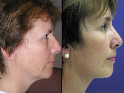 Mini Facelift Before & After Gallery - Patient 106918 - Image 2