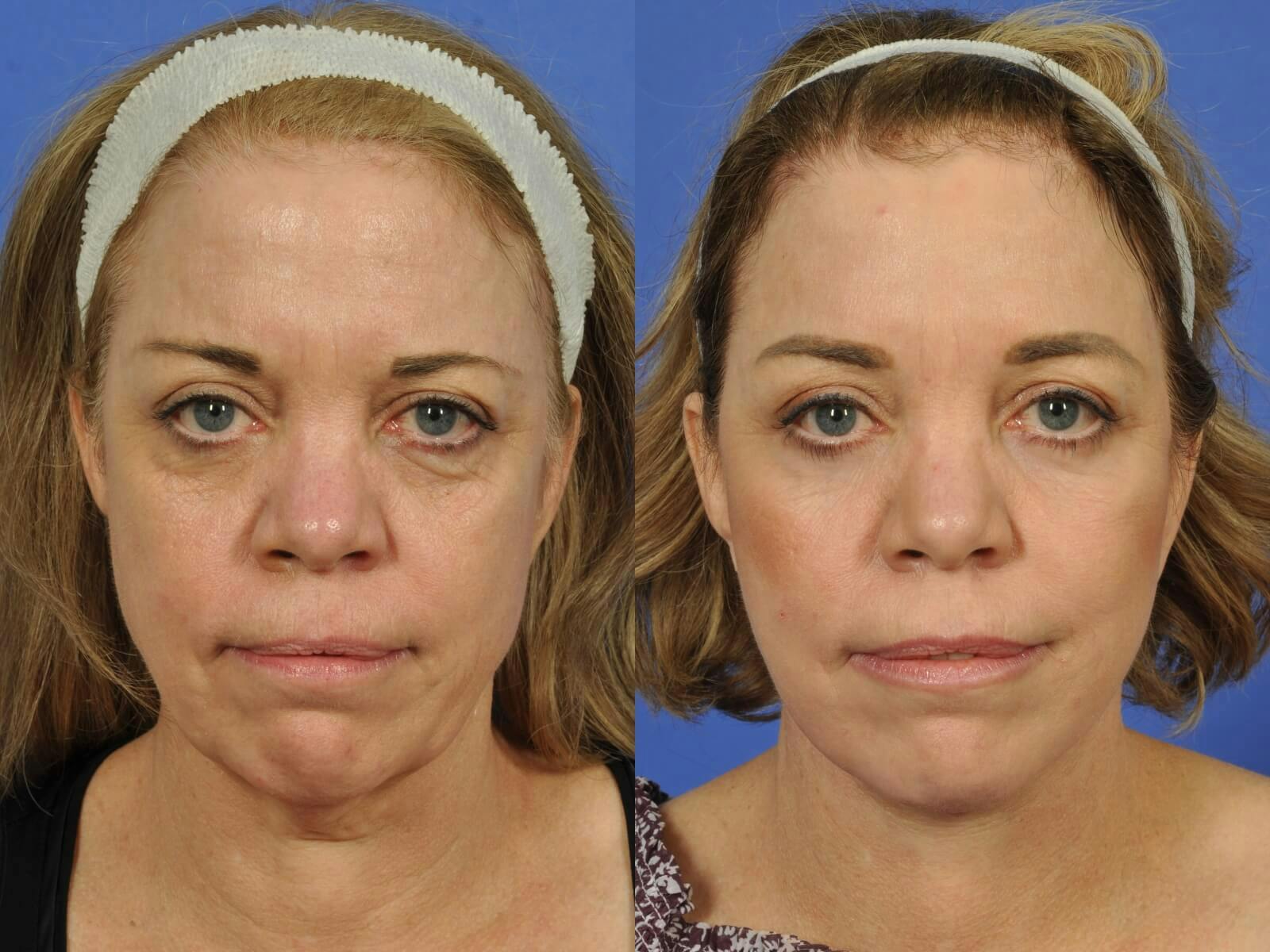 Neck Lift Before & After Gallery - Patient 336460 - Image 1
