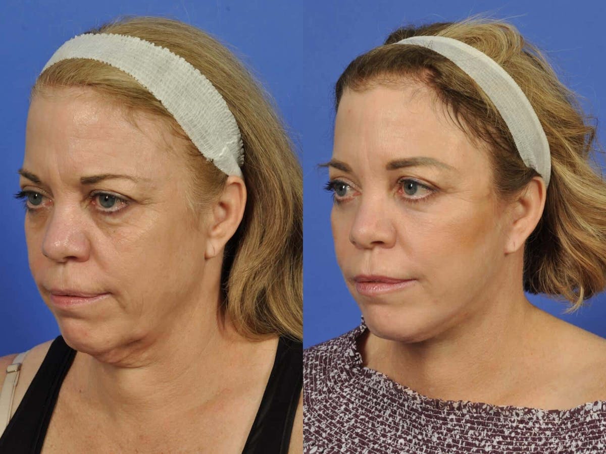 Neck Lift Before & After Gallery - Patient 336460 - Image 2