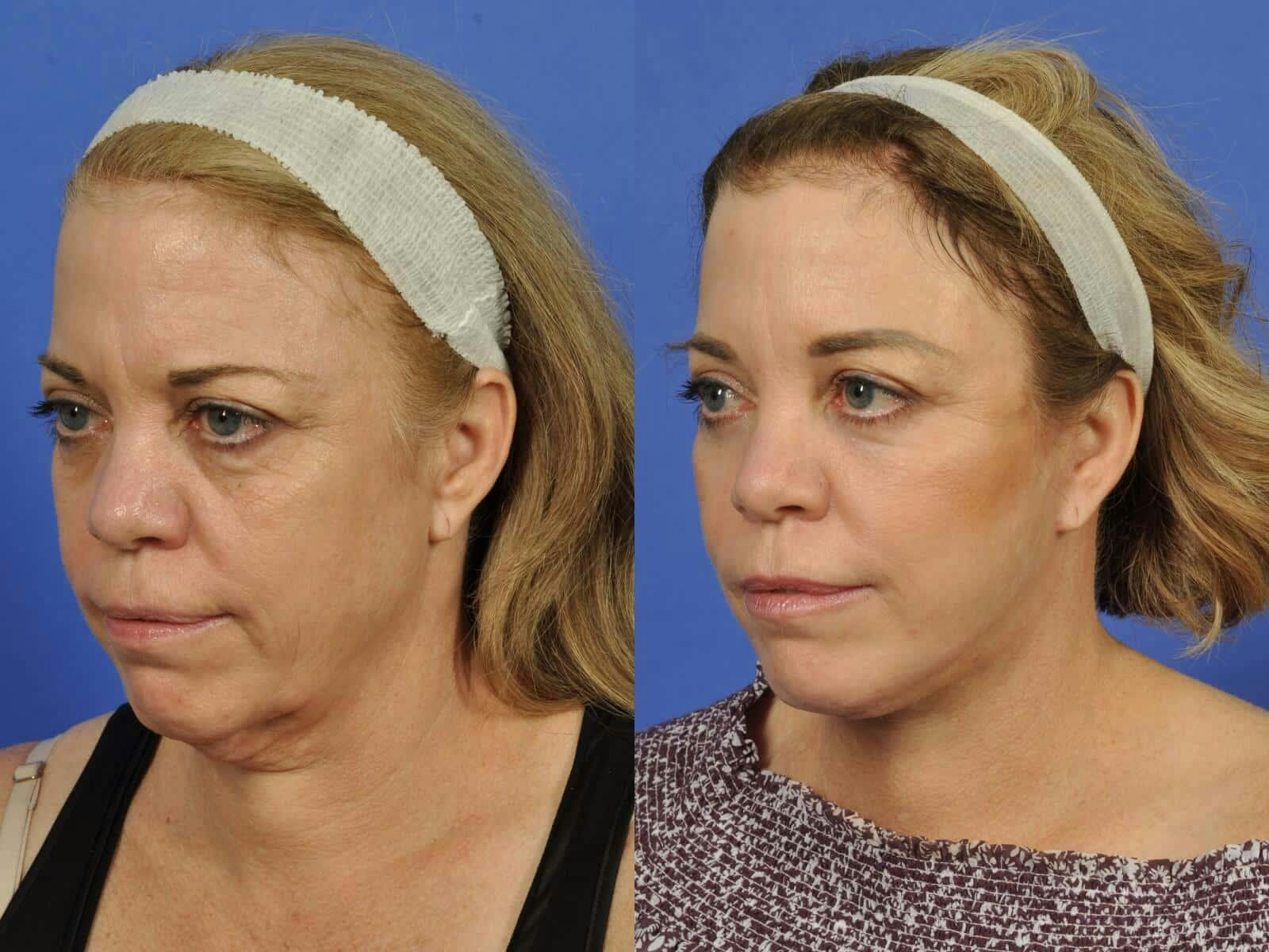 Neck Lift Before & After Gallery - Patient 336460 - Image 2