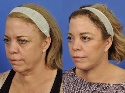 Neck Lift Before & After Gallery - Patient 336460 - Image 2