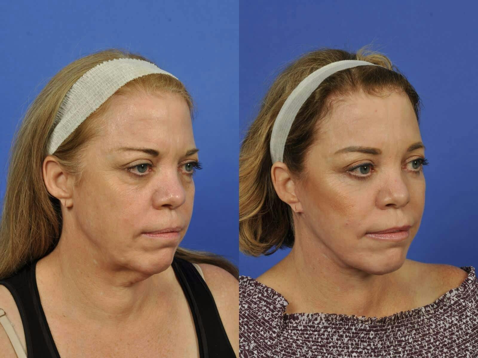 Neck Lift Before & After Gallery - Patient 336460 - Image 3