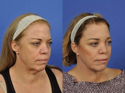 Neck Lift Before & After Gallery - Patient 336460 - Image 3
