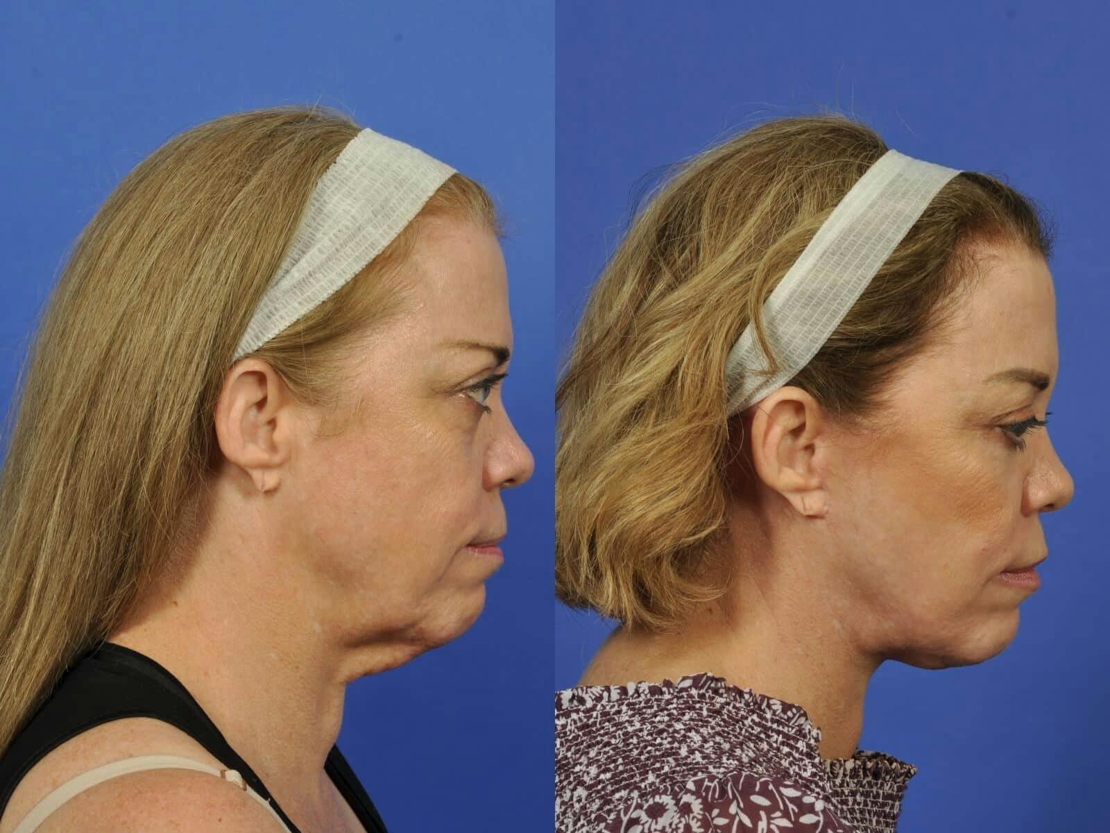 Neck Lift Before & After Gallery - Patient 336460 - Image 5