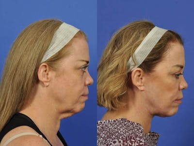 Neck Lift Before & After Gallery - Patient 336460 - Image 5
