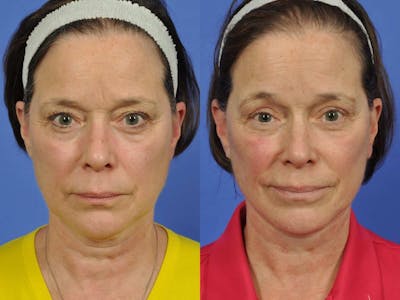 Neck Lift Before & After Gallery - Patient 305792 - Image 1