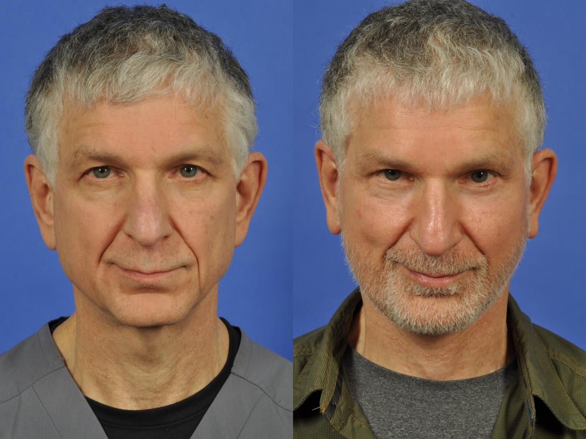 Neck Lift Before & After Gallery - Patient 155448 - Image 1