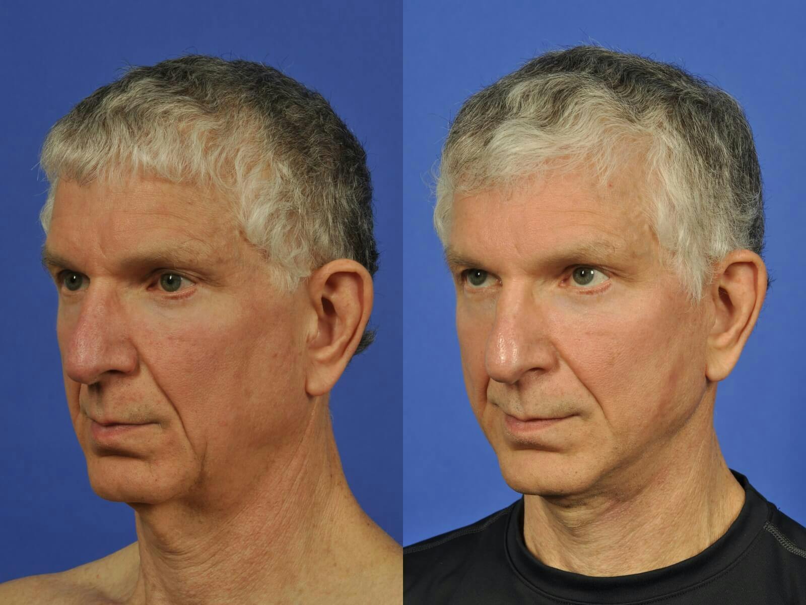 Neck Lift Before & After Gallery - Patient 155448 - Image 2