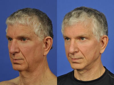 Neck Lift Before & After Gallery - Patient 155448 - Image 2