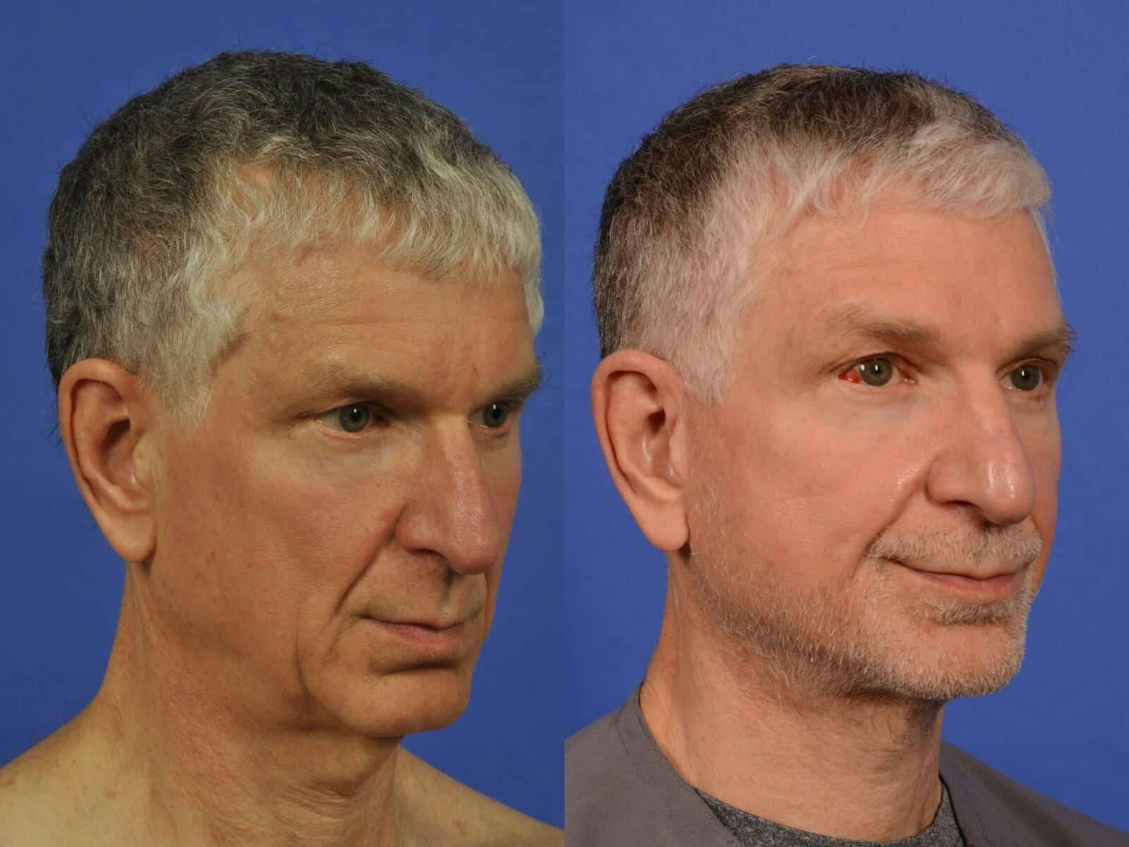 Neck Lift Before & After Gallery - Patient 155448 - Image 3