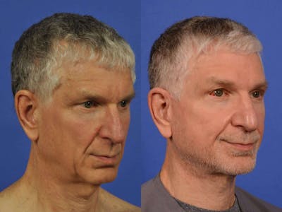 Neck Lift Before & After Gallery - Patient 155448 - Image 3