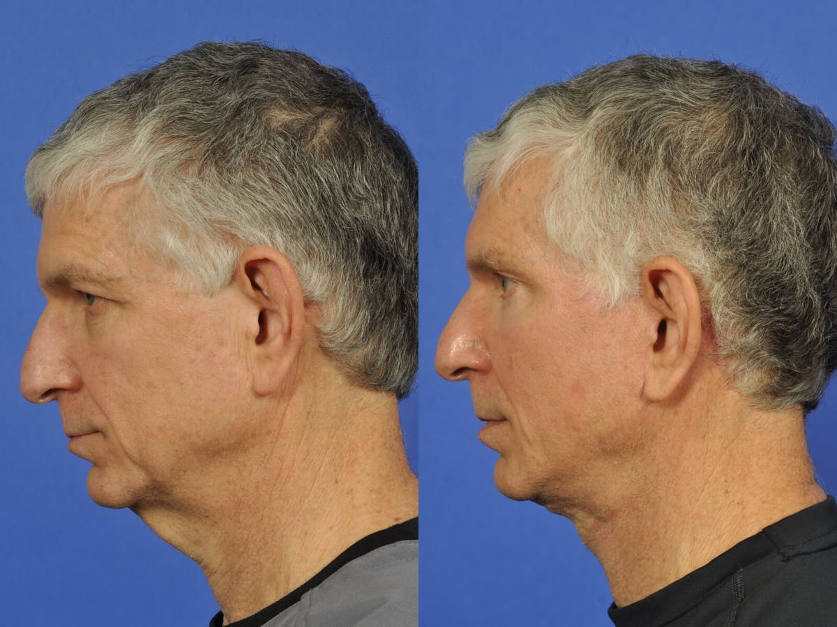 Neck Lift Before & After Gallery - Patient 155448 - Image 4