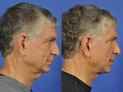 Neck Lift Before & After Gallery - Patient 155448 - Image 5