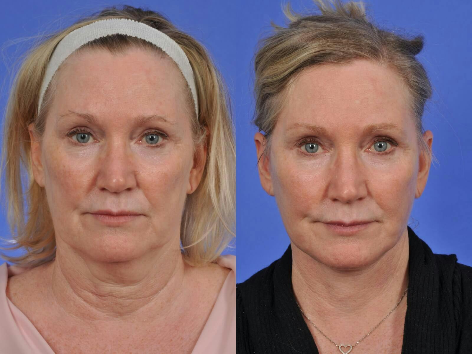 Neck Lift Before & After Gallery - Patient 291122 - Image 1