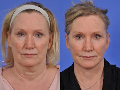 Neck Lift Before & After Gallery - Patient 291122 - Image 1
