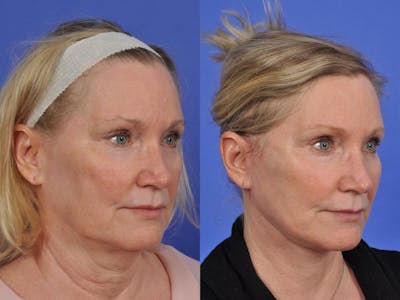 Neck Lift Before & After Gallery - Patient 291122 - Image 3