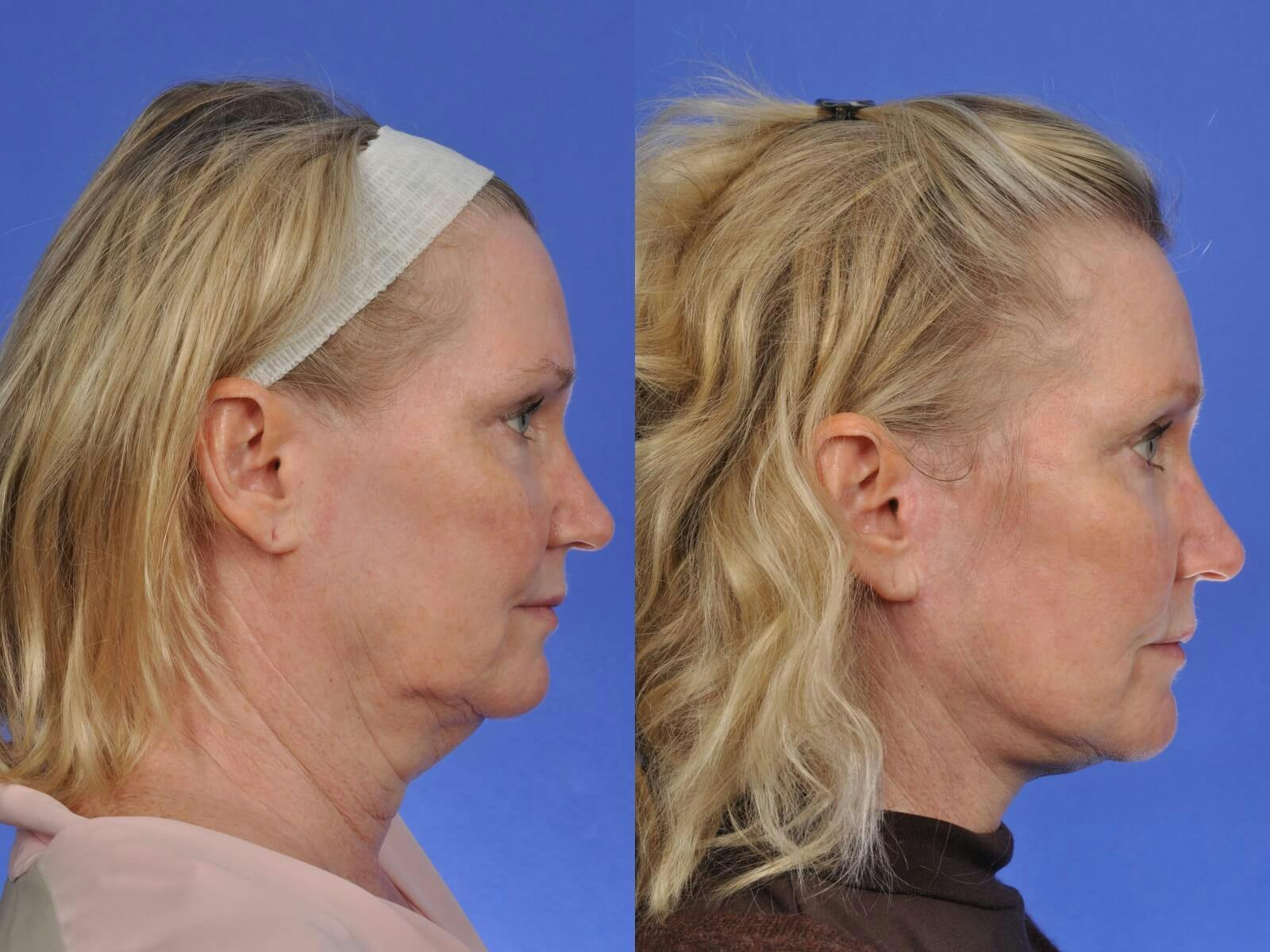 Neck Lift Before & After Gallery - Patient 291122 - Image 4