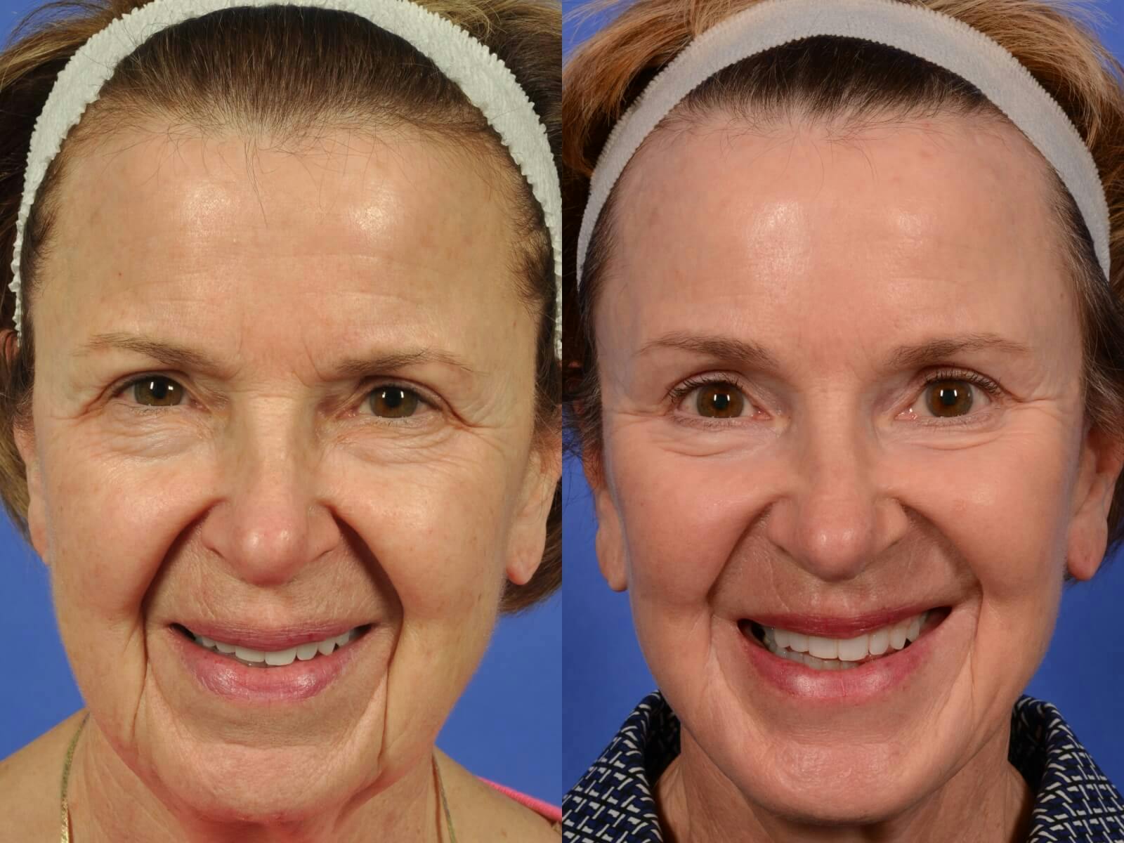 Neck Lift Before & After Gallery - Patient 486034 - Image 1