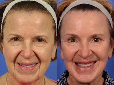 Neck Lift Before & After Gallery - Patient 486034 - Image 1